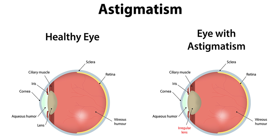 สายตาเอียง Astigmatism สาเหตุ